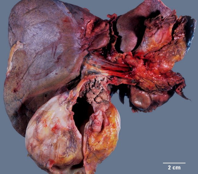 Gall bladder cystic duct carcinoma_resized.jpg